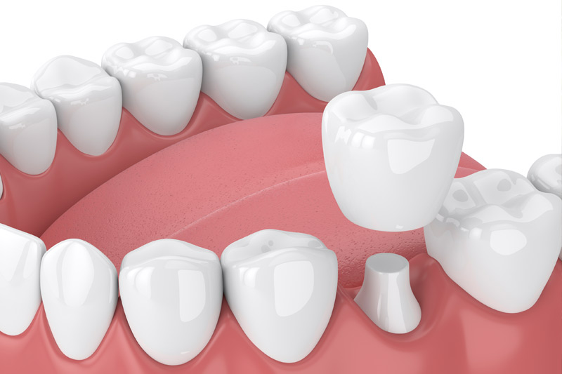 Dental Crowns in Naperville