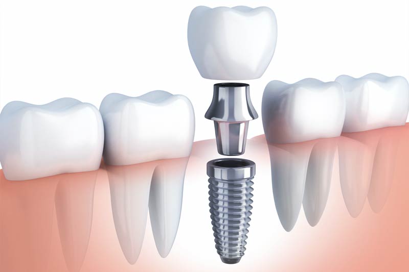 Implants Dentist in Naperville