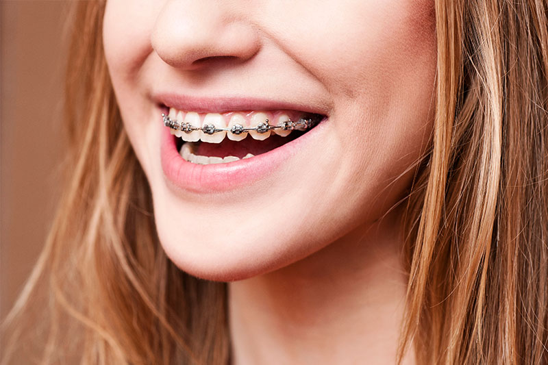 Orthodontics in Naperville