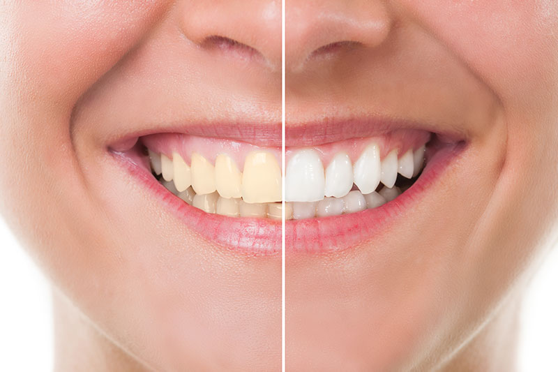 Teeth Whitening in Naperville