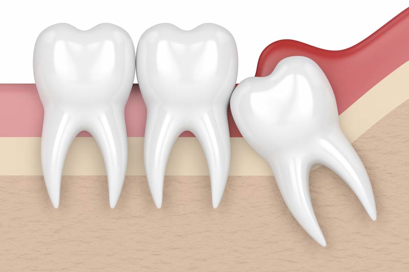 Wisdom Tooth Removal in Naperville